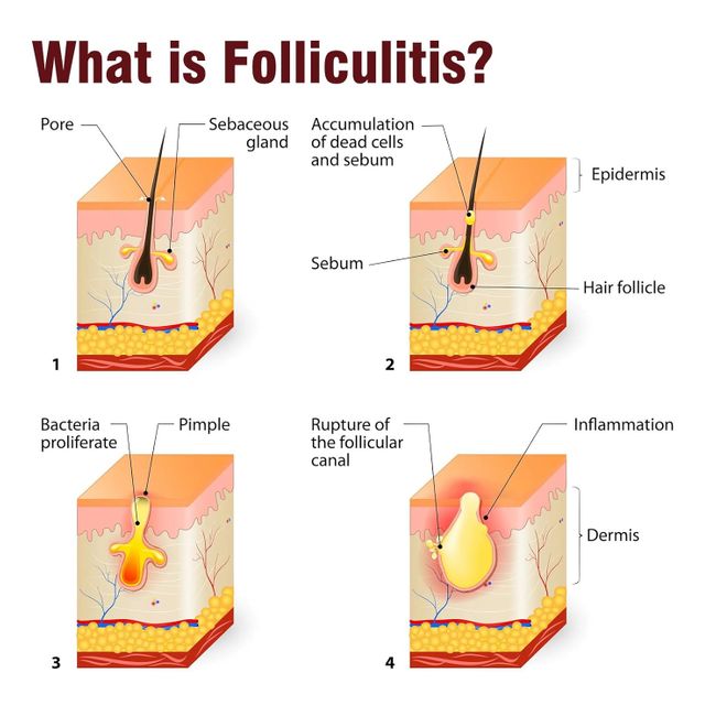 LMNOOP Follikulitis Creme  Kopfhaut & Körperhaut
