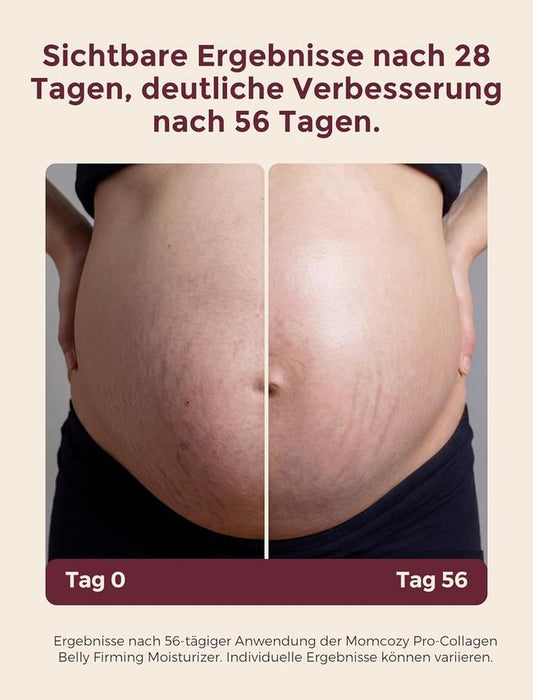 Momcozy Schwangerschaftscreme Dehnungsstreifen Vorbeugung