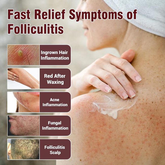 LMNOOP Follikulitis Creme  Kopfhaut & Körperhaut