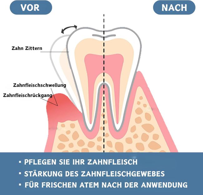 SUMMISHI Zahnfleisch Reparatur Spray & Tropfen