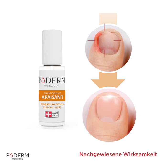 EINGEWACHSENE GEKRÜMMTE NÄGEL | Rein pflanzliche Behandlung| Beruhigt, lindert, nährt und revitalisiert | Professionelle Fuß- und Handpflege 