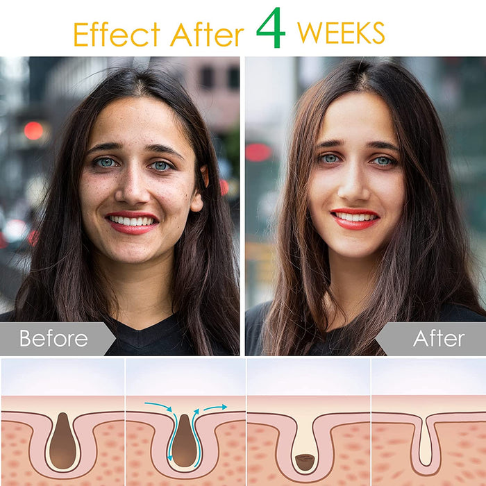 Pigmentflecken Entferner, Gesichtspflege gegen Pigmentflecken und Altersflecken, für einen ebenmäßigen & strahlenden Teint, 30 ml