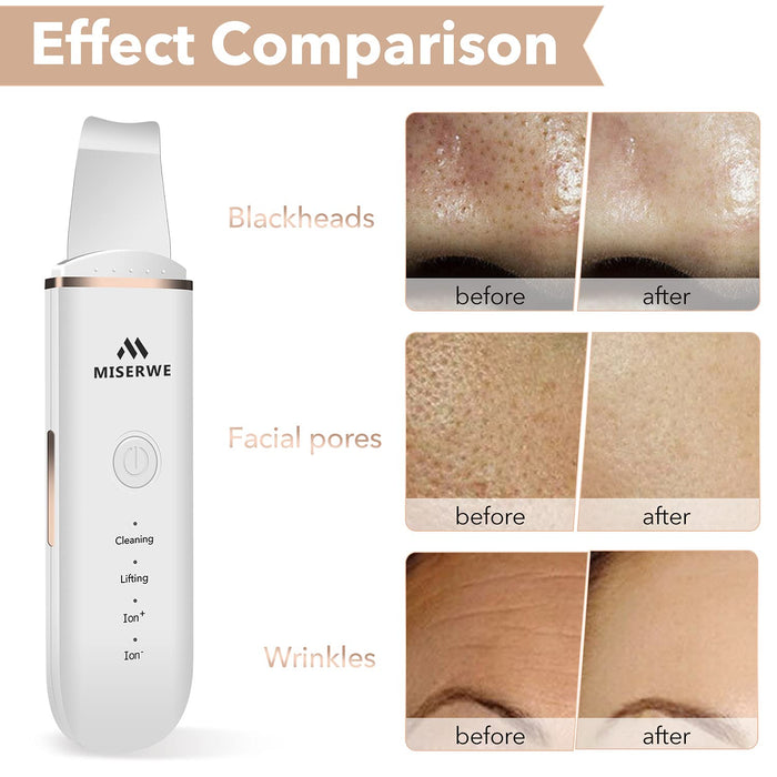 Face Skin Spatula Ultraschallpeelinggerät Skin Scrubber Mitesserentferner Porenreiniger Gesicht Schönheitspflege Gesichtslifting Werkzeug Mitesser