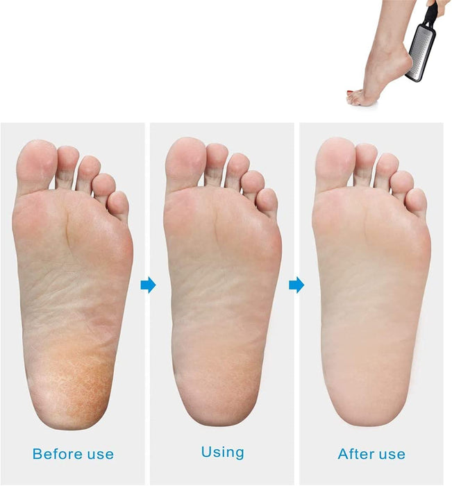 Hornhauthobel, Hornhautentferner Entferner Harte Haut, Dicker Kallus and Hühneraugen Entfernen, Edelstahl Fussfeile Hornhautentferner Hilfsmittel